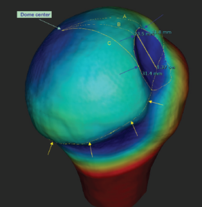 The Global Track Concept for Assessment of Engaging Hill-Sachs Defects in Anterior Shoulder Instability